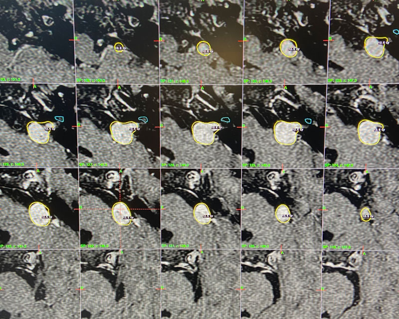 55 year old woman with one year of progressive hearing loss in the left ear / Acoustic Neuroma 3