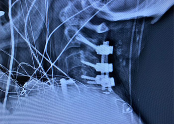 Cervical Laminectomy feature