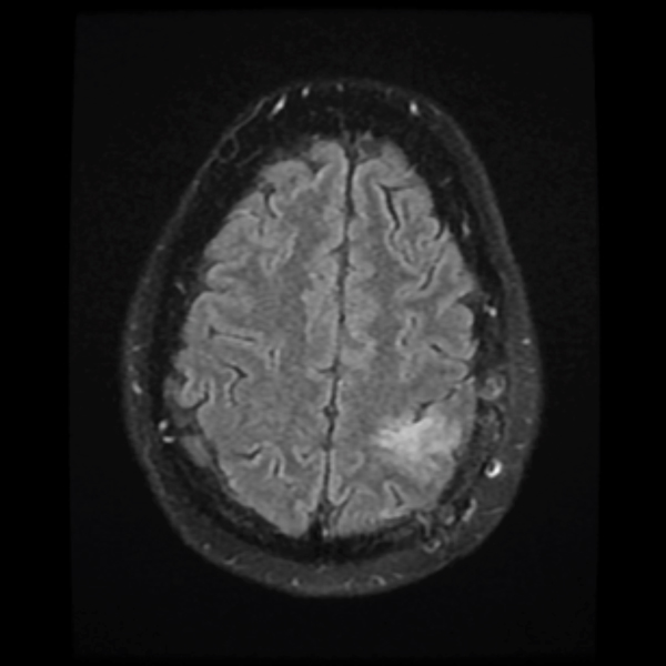 Grade II Oligodendroglioma 2