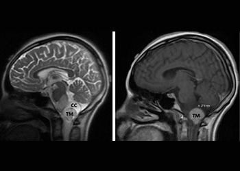 Hemangloblastoma featured new