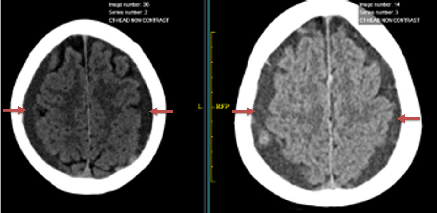 A) 6 weeks post mild trauma B) 4 weeks post mild trauma demonstrate stable subacute subdural collections with mild growth and sulcal effacement