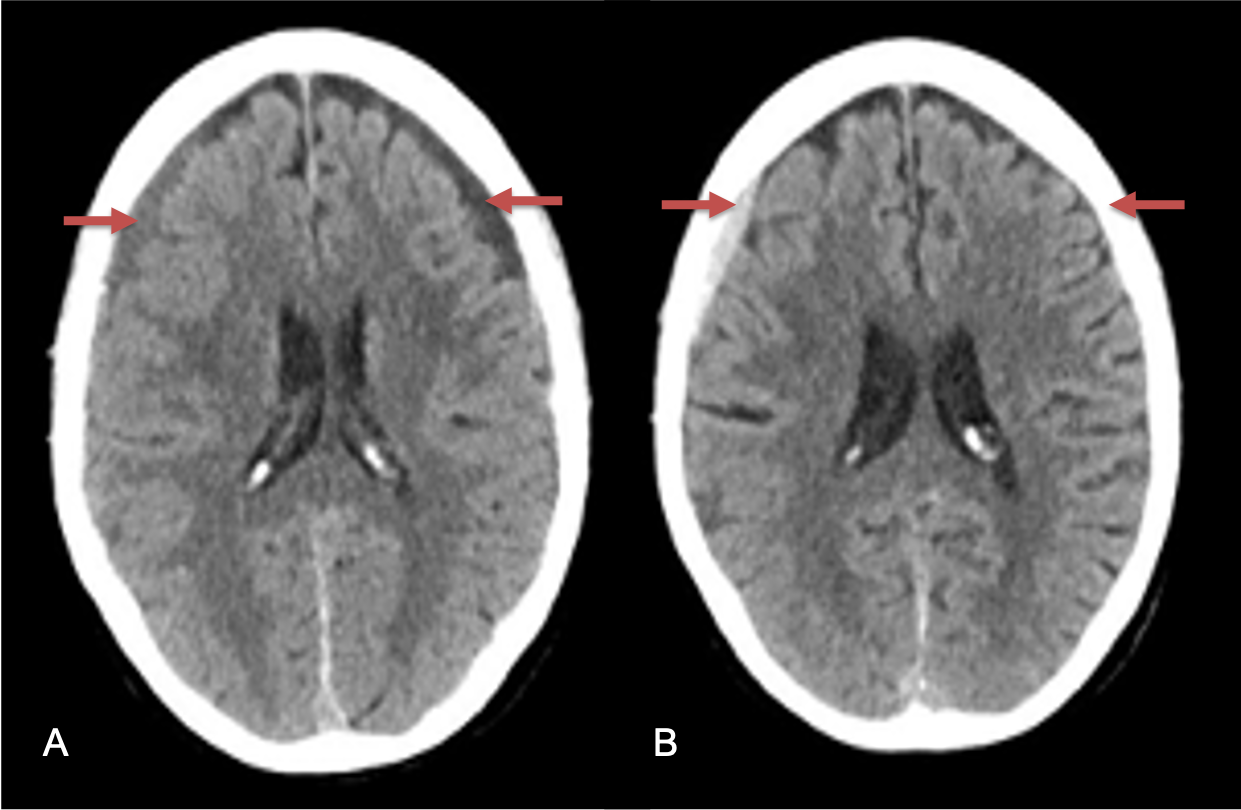 A) 1 week post MMA embolization demonstrating decreasing thickness bilaterally B) 2 weeks post MMA demonstrates resolution on left, with small new acute component on right with overall decreased thickness