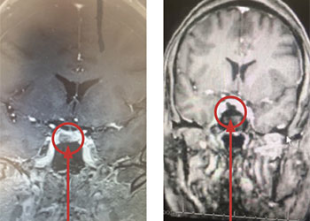 Pituitary feature