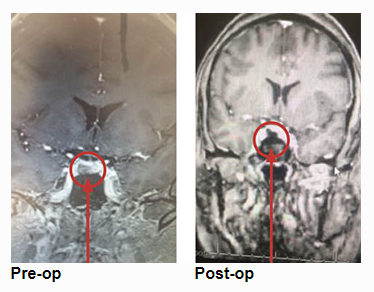 Pituitary Tumor with Cushing's Disease