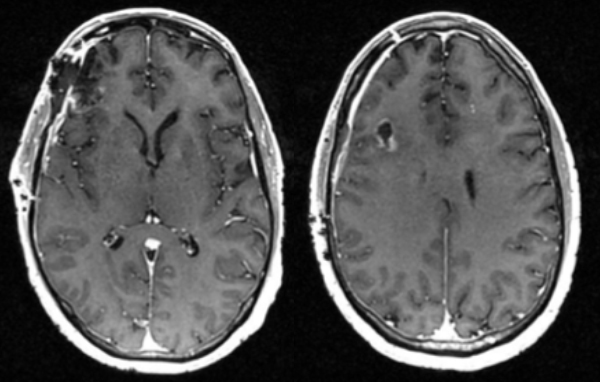 Cerebral Metastases from Non-Small Cell Lung Cancer 2