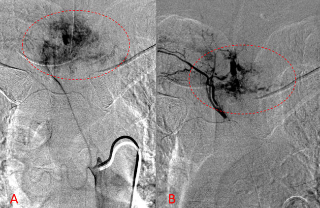 Spinal Embolization Treats Aggressive Comprehensive T3 Verterbral Body Hemangioma 3