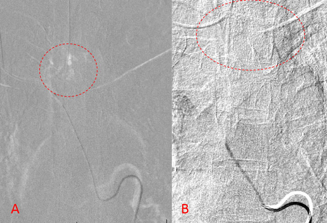 Spinal Embolization Treats Aggressive Comprehensive T3 Verterbral Body Hemangioma 4