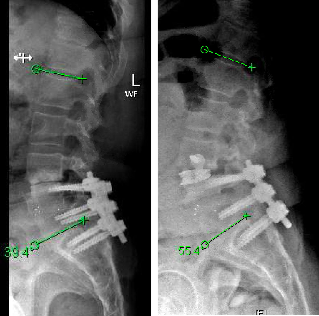 Minimally Invasive Approach for Spinal Revision Surgery