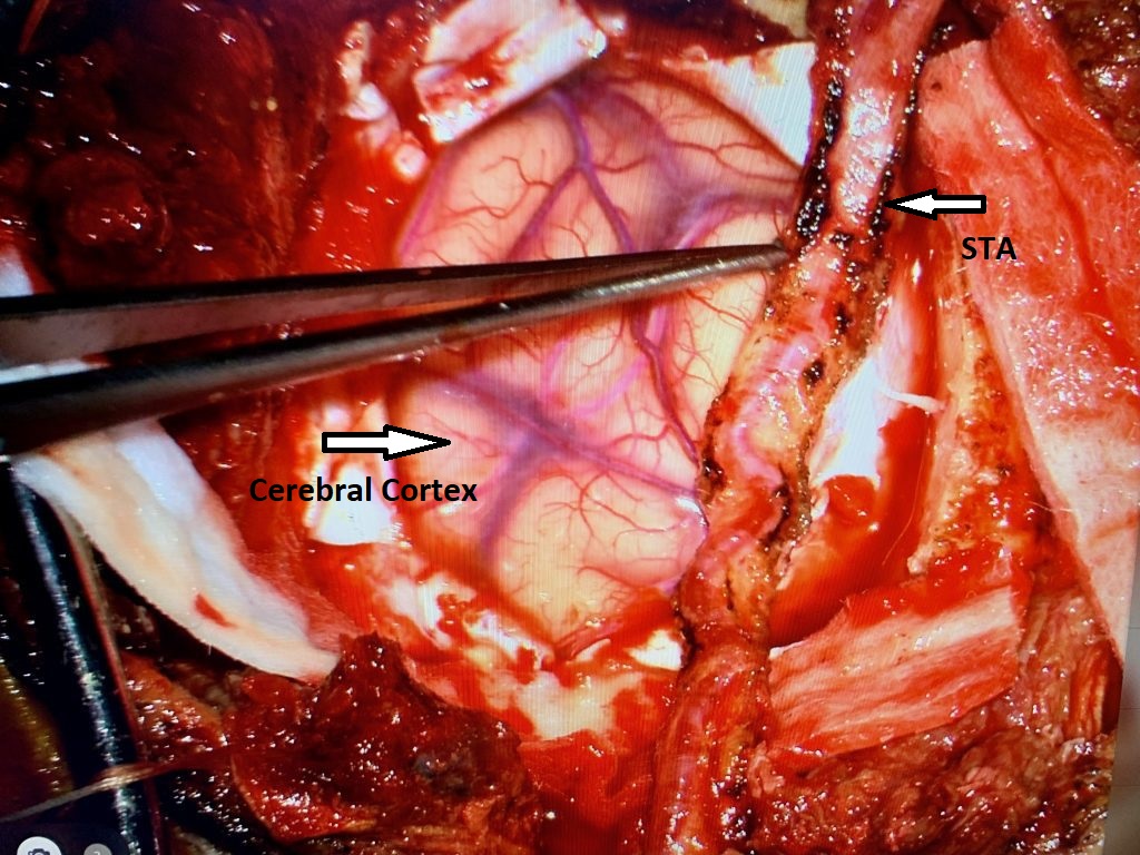 Dr. J. Brisman EDAS Case Summary Fig. 3 Image At Treatment Completed Right Sided EDAS Procedurefinal 2