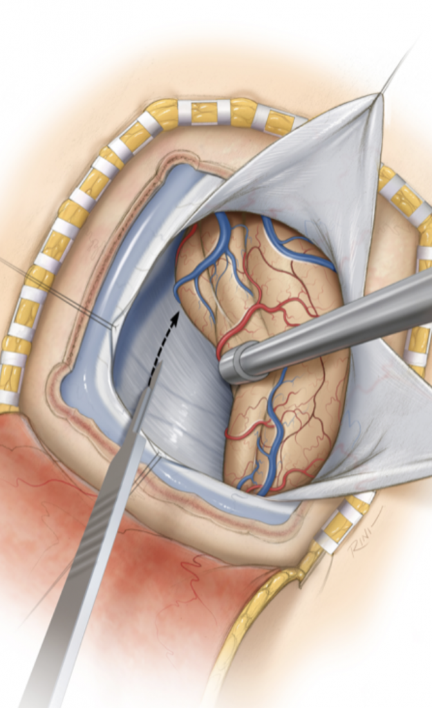 Pineal Region Meningioma 3