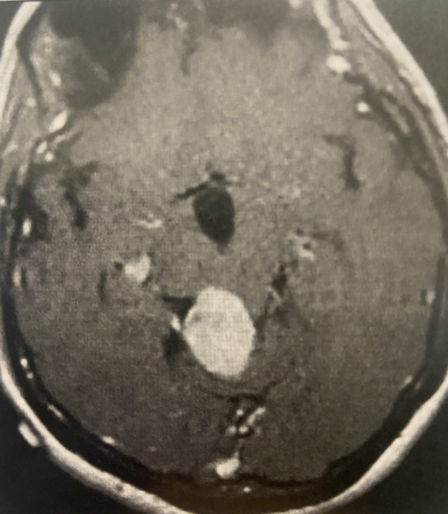 Pineal Region Meningioma 1