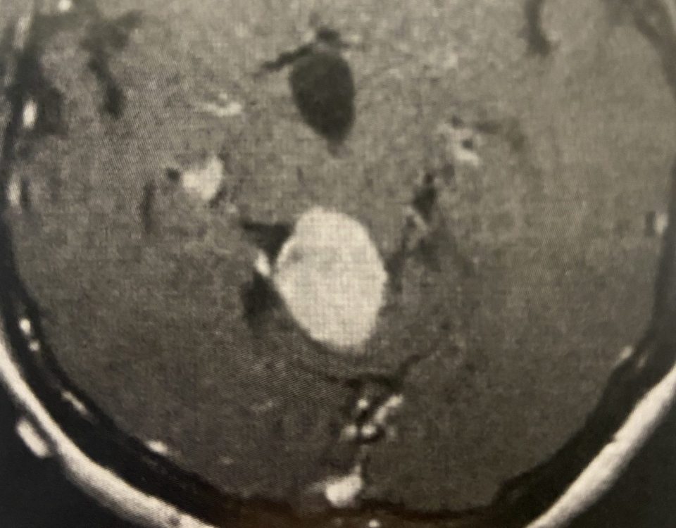 Pineal Region MeningiomaImage1 1 scaled e1643817820993