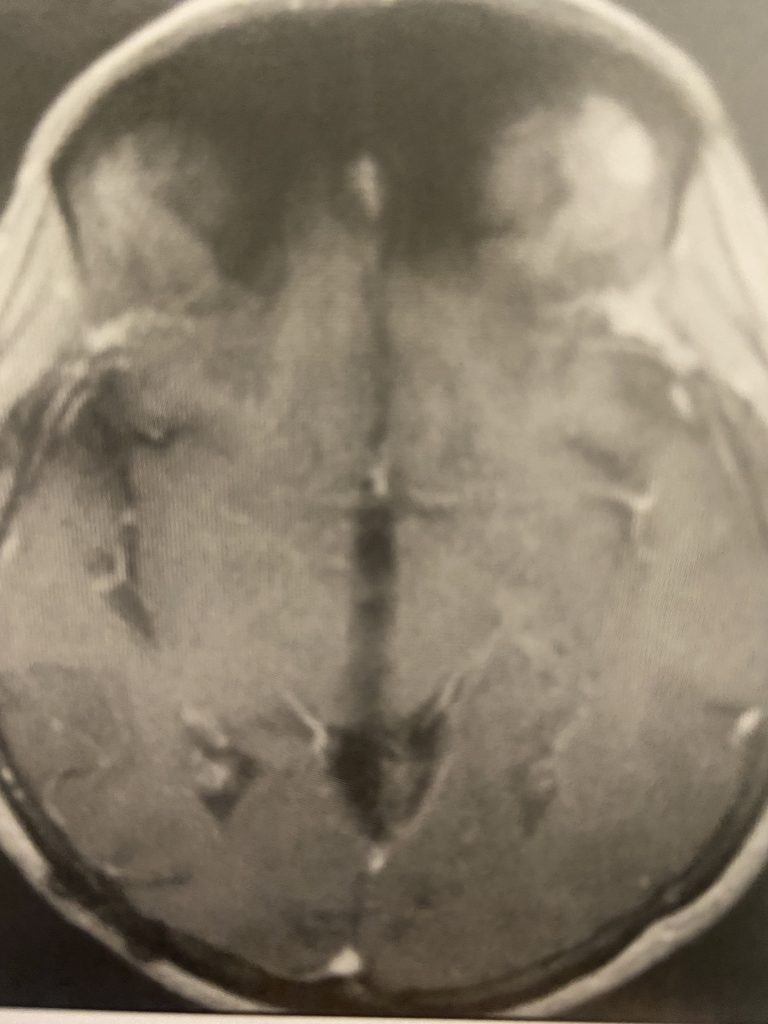 Pineal Region Meningioma 4