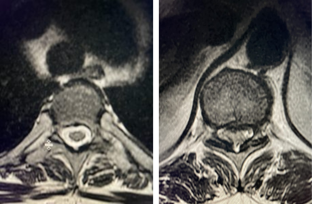 fig 2 thoracic