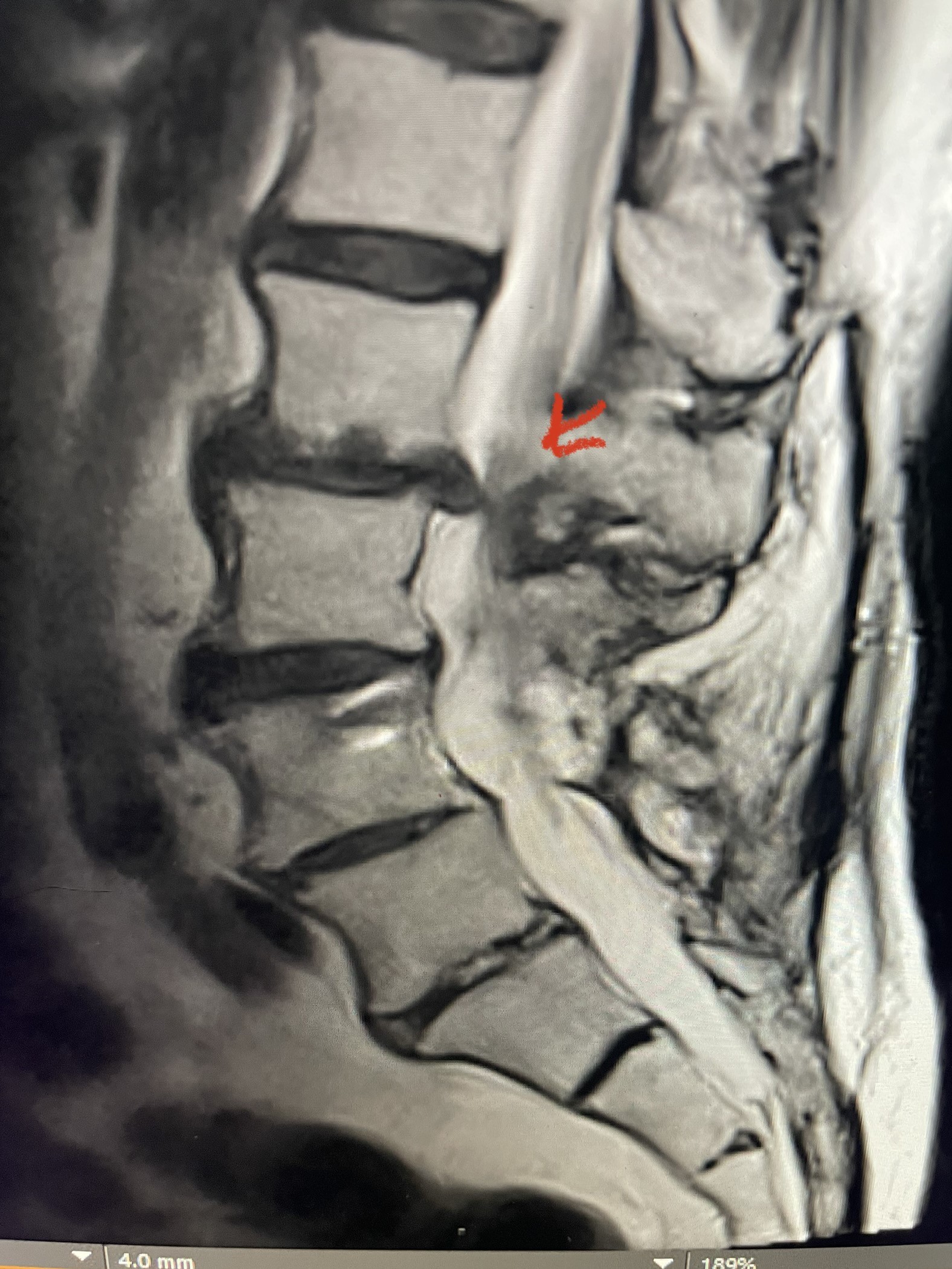 Fig 1 Sagittal and axial T2 weighted lumbar and 1B L4-S1 instrumented fusion