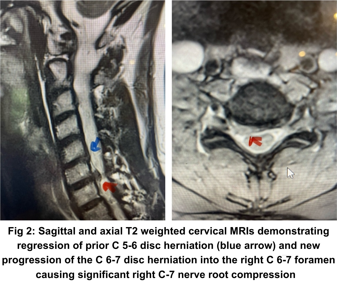 NSPC Brain & Spine Surgery Fig 2