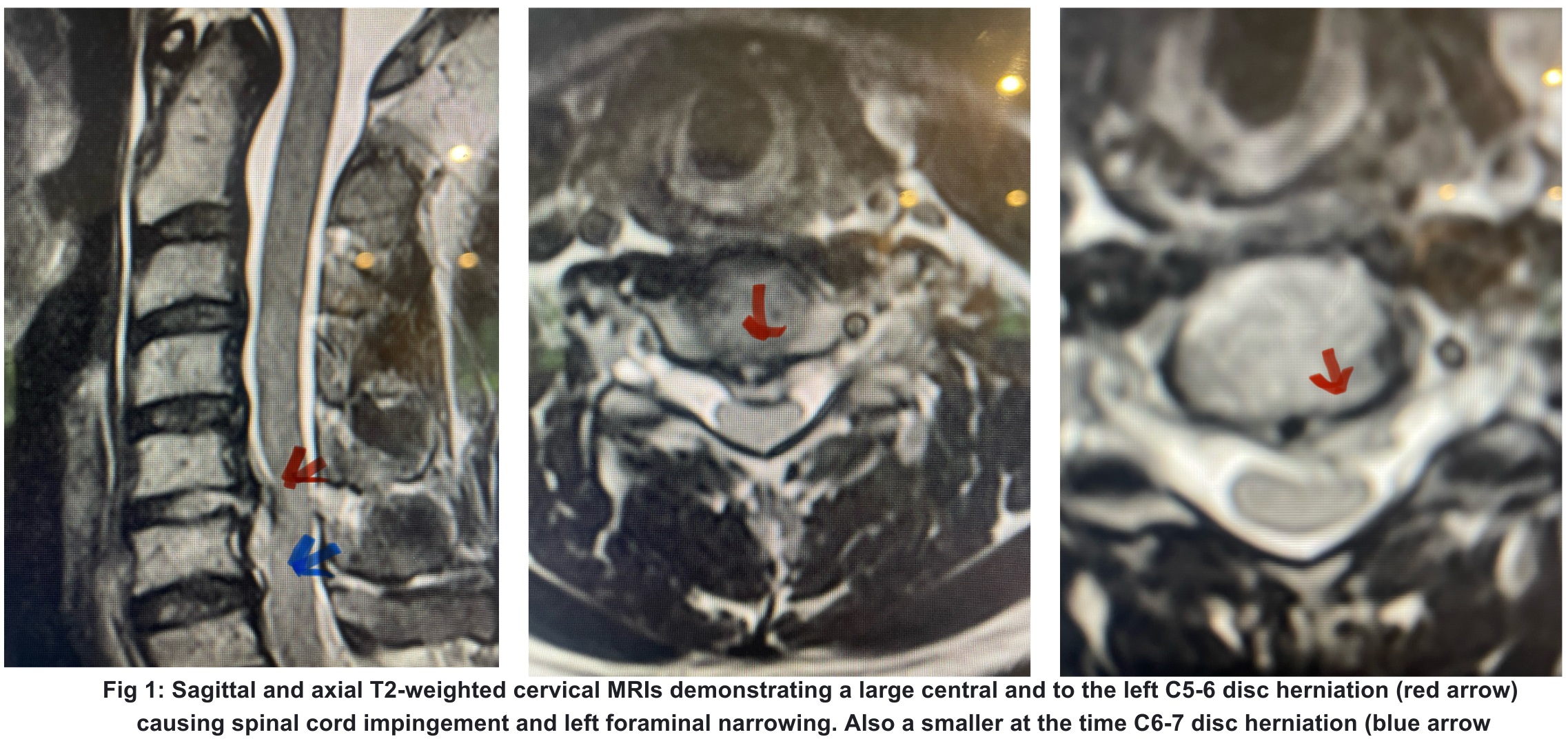 NSPC-Brain-Spine-Surgery fig 1